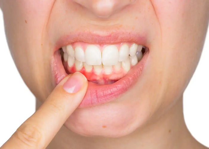 4 Signs You Have Gum Disease