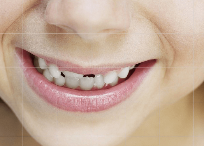 Teeth restoration simplified Check this overview