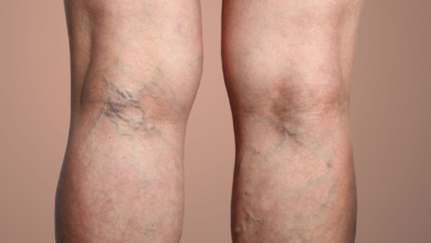 Spider Veins - Typical Locations and Minimal-Invasive Treatment Options In Boise
