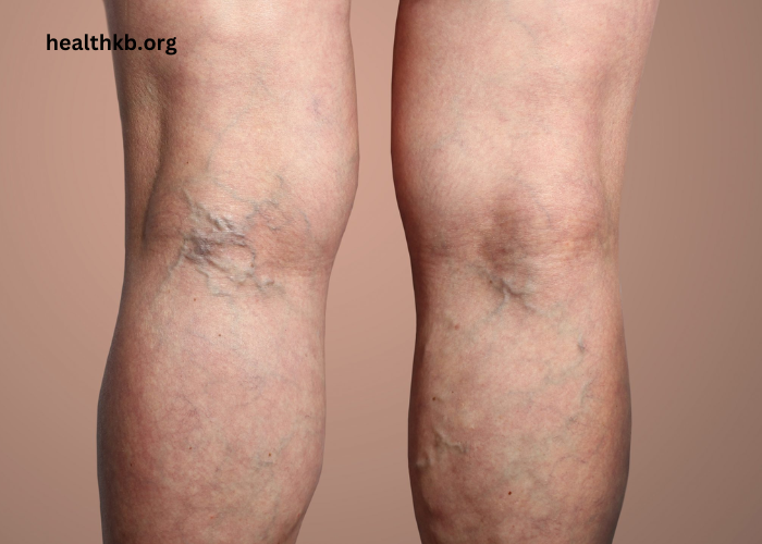 Spider Veins - Typical Locations and Minimal-Invasive Treatment Options In Boise
